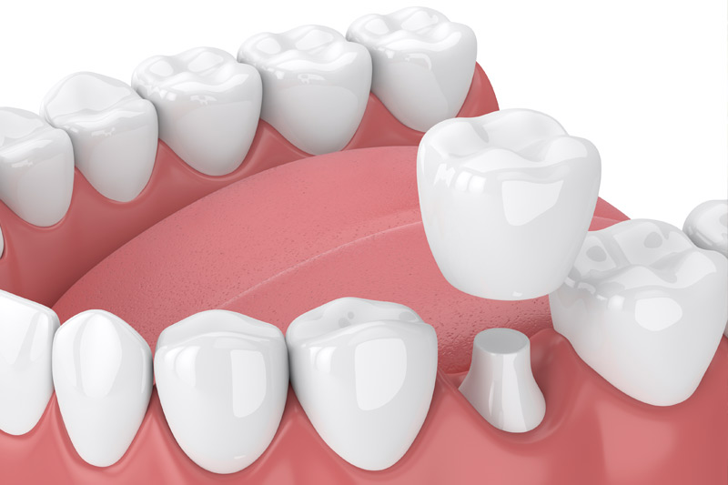 Dental Crowns in Fort Worth