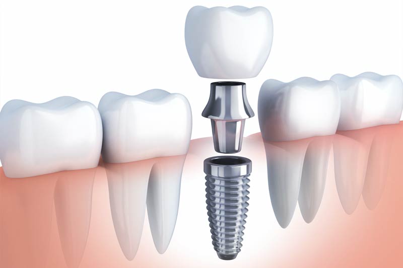 Implants Dentist in Fort Worth