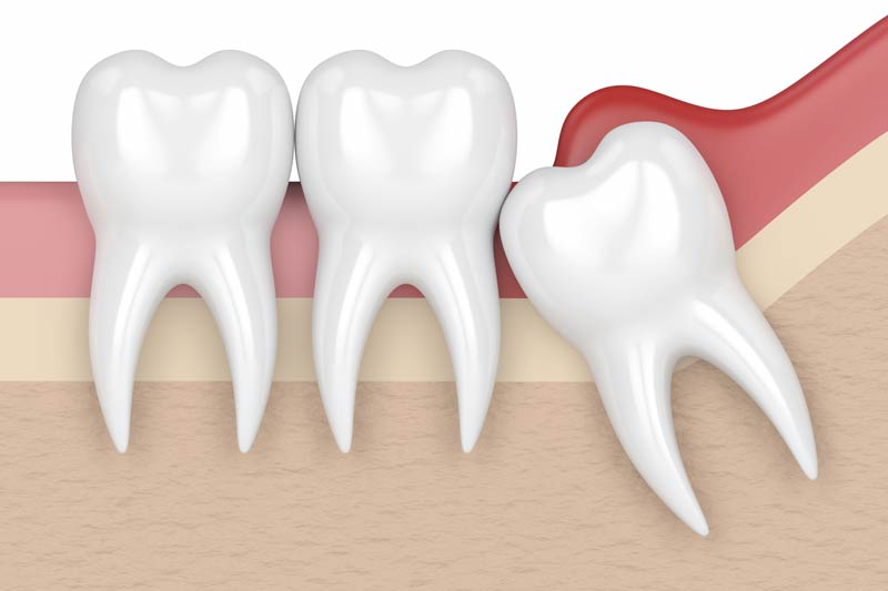 Wisdom Tooth Removal in Fort Worth